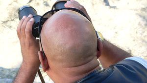 Косопадът е сериозен проблем при мъжете