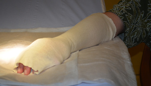 Счупена ръка по време на почивка