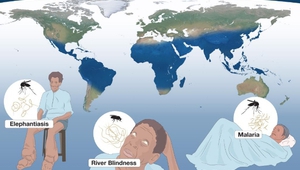 "Нобел" за борбата с елефантиазата, речната слепота и маларията