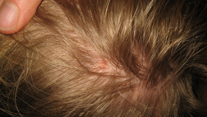 Въшки в косата