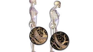 Жена с нормална стойка (вляво) и увредена от остеопороза