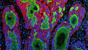 Ракови клетки на меланома