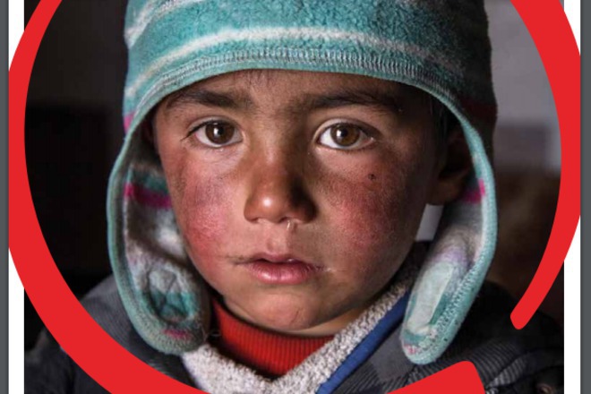 Detsata na siriya stradat i ot nevidimi rani