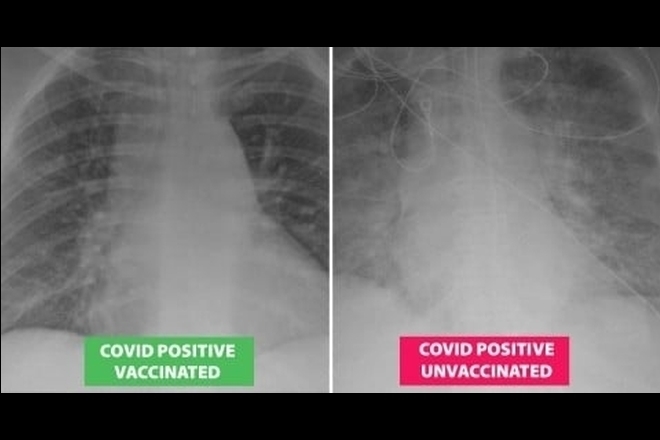 COVID-19 в белия дроб при ваксиниран (вляво) и неваксиниран