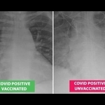 COVID-19 в белия дроб при ваксиниран (вляво) и неваксиниран